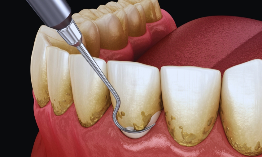 professional teeth cleaning vs at home care