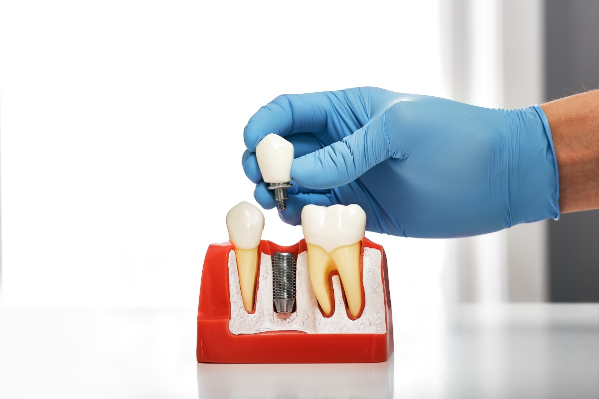 Dental implants in Glendora