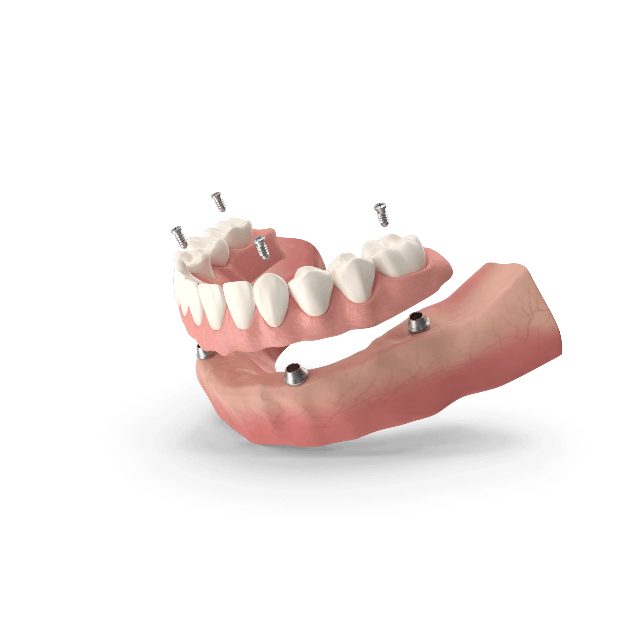 How Long Do Dentures Last