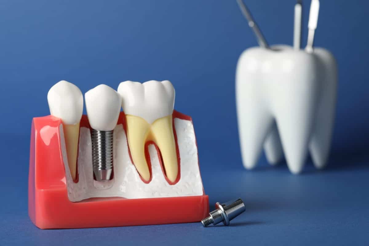 Dental Implants in Citrus